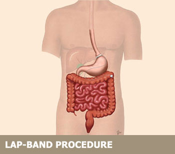 Gastric Sleeve vs. Lap Band Comparison with Lap Band Image