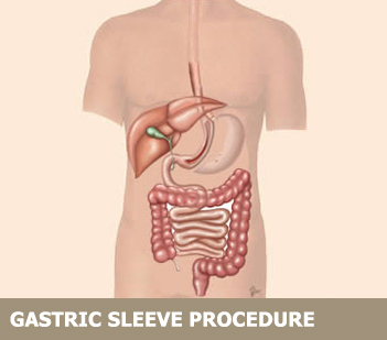 Gastric Sleeve vs. Lap Band comparison with Gastric Sleeve Image