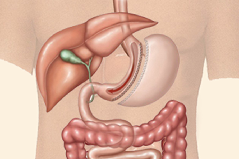 Gastric Sleeve Surgery