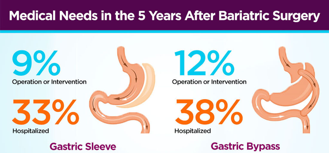 Study shows long-term complications with Gastric Sleeve Surgery