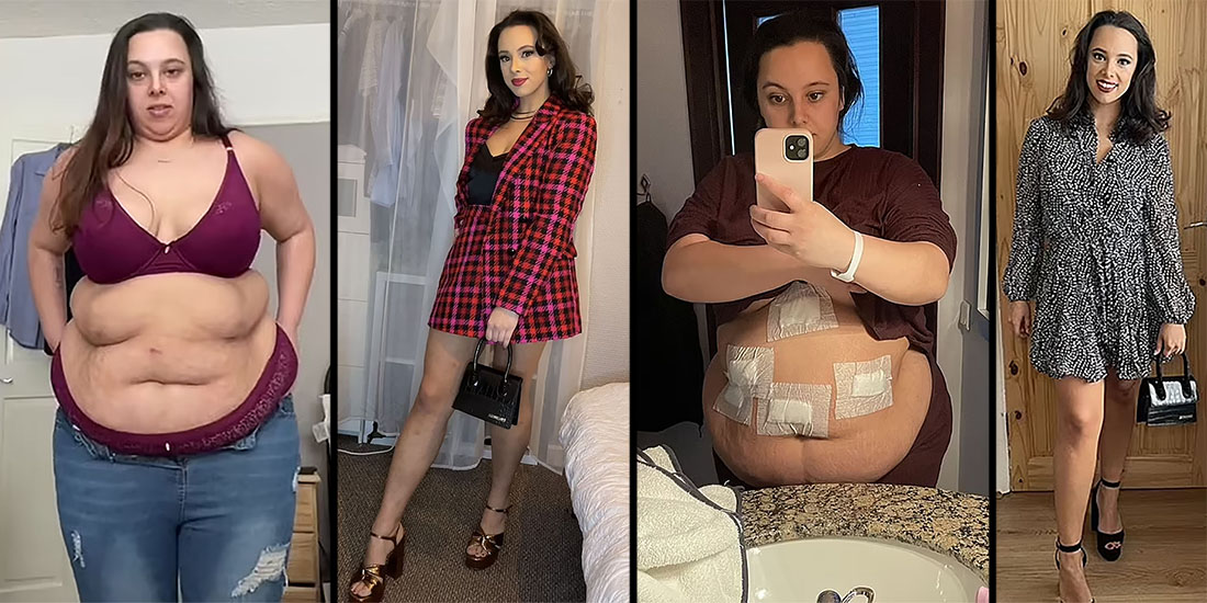Ashlie F has lost over 146 lbs after one year of having Gastric Sleeve  Surgery