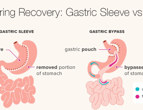 Faster Recovery: Gastric Sleeve Surgery vs. Gastric Bypass with Dr. Kuri in Mexico